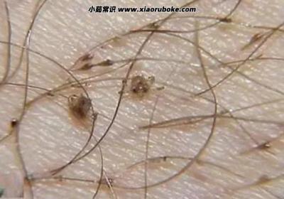 陰虱怎么徹底去除最簡單的方法，三分鐘完全去除陰虱卵(簡單快速)