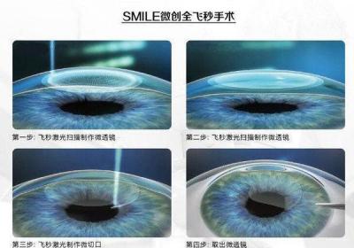 ?對比一下激光近視手術和ICL晶體植入哪個更好？