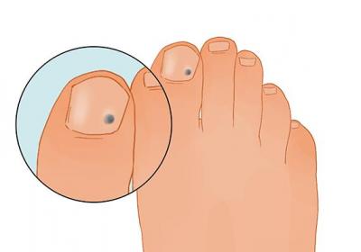 灰指甲用什么藥